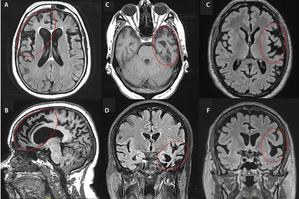 Relationship of Hate to Dehumanization in Neurotypical Individuals compared to those with Frontotemporal Dementia